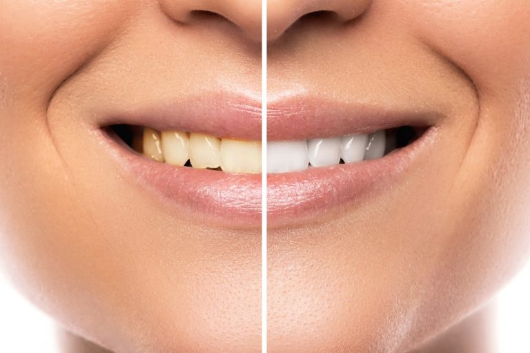 How Much Does Teeth Whitening Cost? A Quick Guide