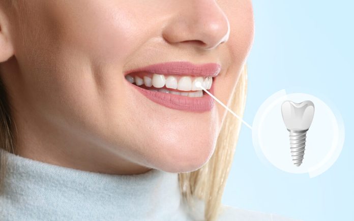 a simple look at the history of dental implants