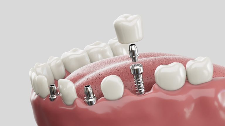 Restoring Your Smile with Implant Supported Dentures in Red Deer