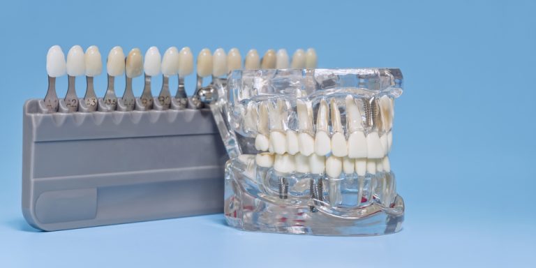 Restoring Your Smile with Multi Tooth Implants in Calgary