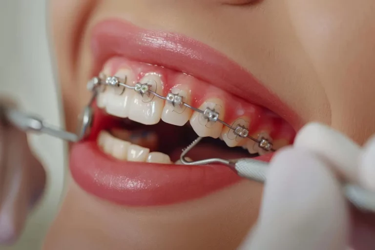 clips and braces mg