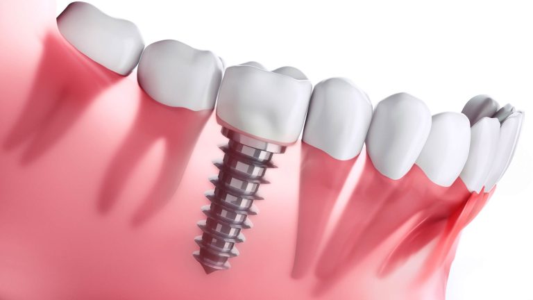 dental implant in richmond