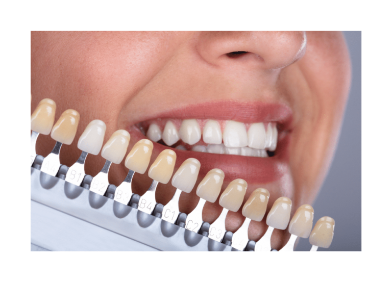 Tooth-Colored Fillings in Red Deer, Alberta