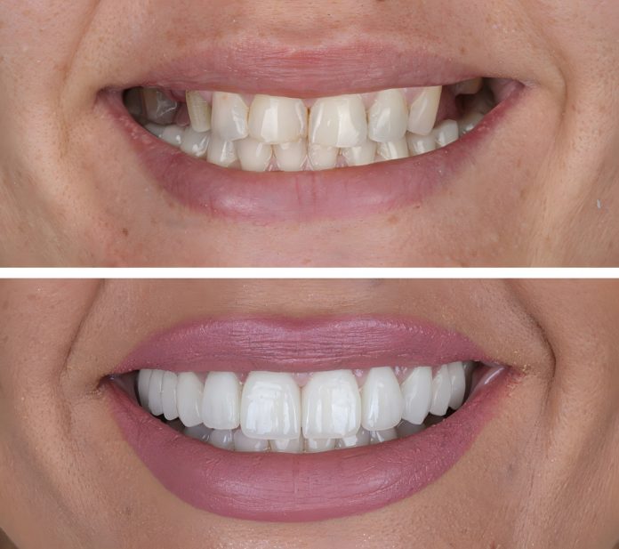 Top Benefits of Smile Makeovers for a Confident You Top Benefits of Smile Makeovers for a Confident You