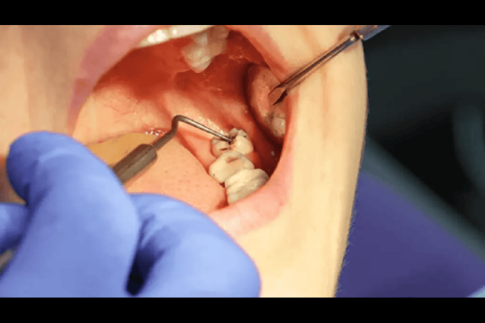 wisdom teeth extractions in lloydminster