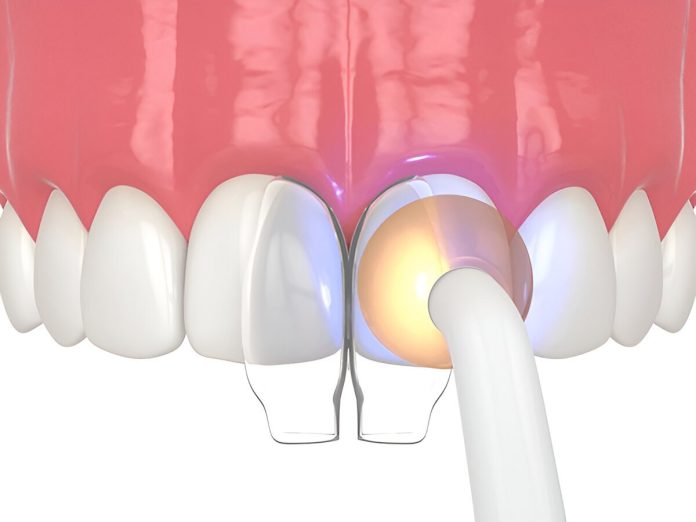 dental-bonding-in-etobicoke-on