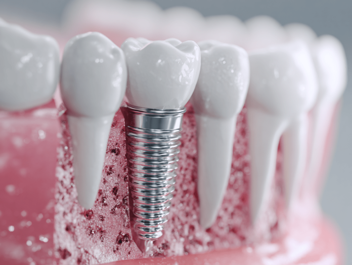 dental-implants-in-langley how long do dental implants last success factors explained