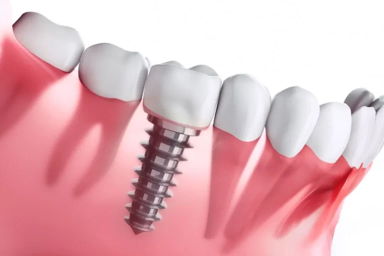 Dental Implants in Richmond: What to Expect From Consultation to Recovery