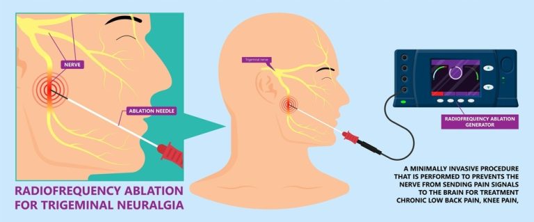 Radiofrequency-Neurotomy