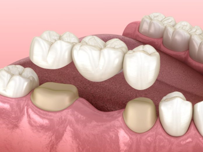 are dental implants worth it benefits you should know