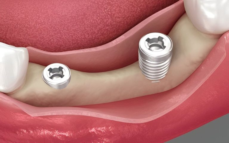 teeth in a day in coquitlam