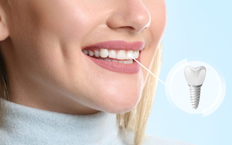 metal-free dental implants vs traditional implants which is right for you