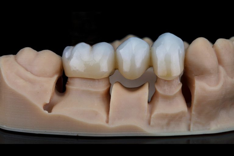 dental bridges near you