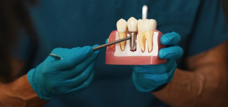 dental implants in mill bay