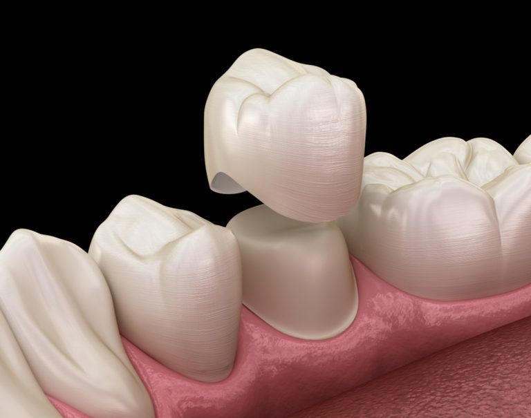 what happens during a dental crown procedure a step-by-step guide