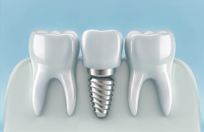 dental implants