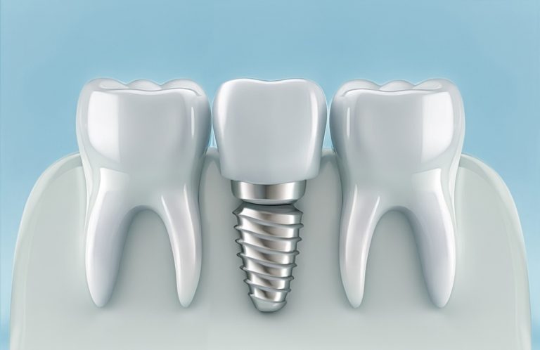 dental implants